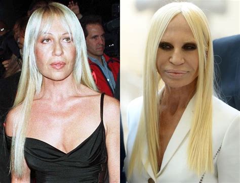 ema donatella versace|donatella versace before and after surgery.